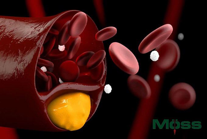 Cholesterol xấu (LDL) gây tắc nghẽn thành mạch