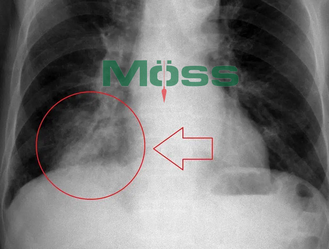 Chụp X Quang là phương pháp đơn giản để chẩn đoán viêm phổi