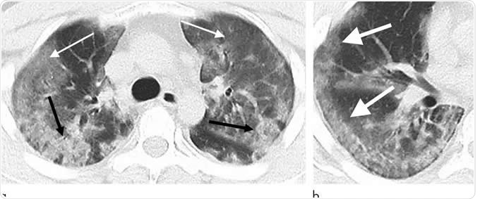 Ảnh chụp CT lồng ngực bệnh nhân nhiễm SARS-CoV-2